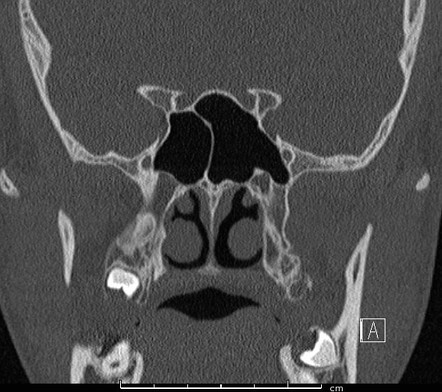 Haller Cell | Radiology Case | Radiopaedia.org