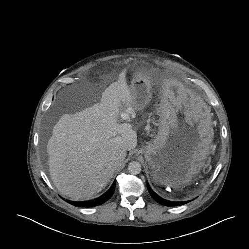 File:Portal hypertensive gastropathy, enteropathy, and colopathy ...