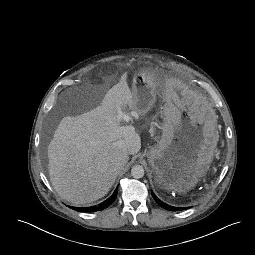 File:Portal hypertensive gastropathy, enteropathy, and colopathy ...