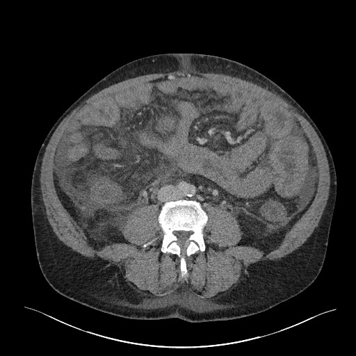 File:Portal hypertensive gastropathy, enteropathy, and colopathy ...