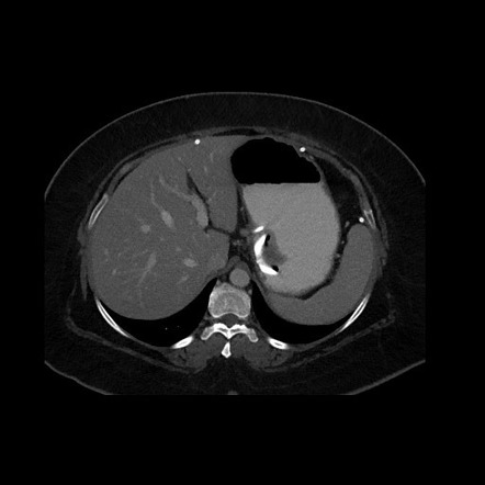 Gastric band erosion | Radiology Reference Article | Radiopaedia.org