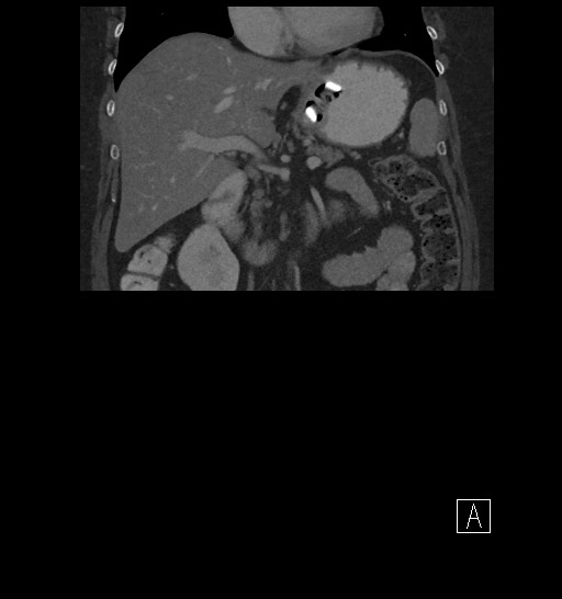 Gastric band erosion | Image | Radiopaedia.org