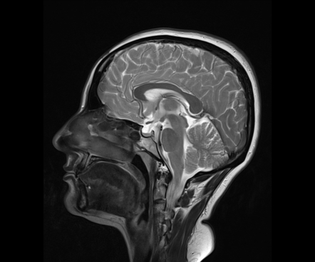 Pituitary microadenoma | Image | Radiopaedia.org