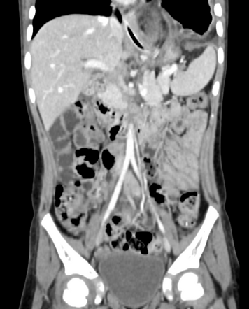 Bochdalek hernia - delayed presentation | Radiology Case | Radiopaedia.org