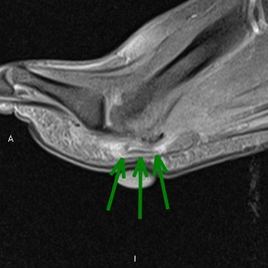 Plantar Vein Thrombosis Radiology Case Radiopaedia Org