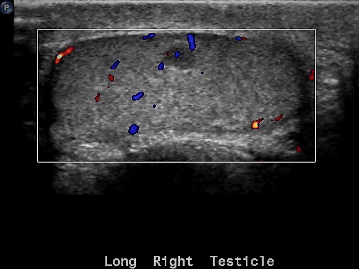 Leydig Cell Tumor Of The Testis Image