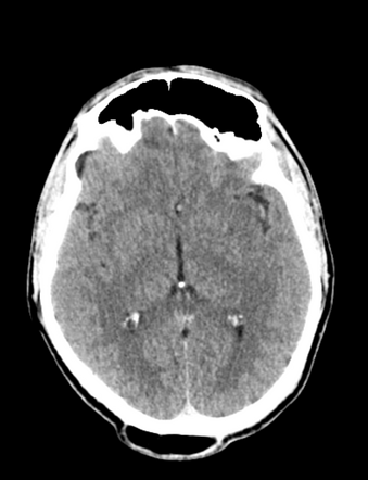 Subgaleal lipoma | Radiology Reference Article | Radiopaedia.org