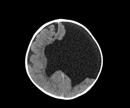 Schizencephaly | Radiology Reference Article | Radiopaedia.org