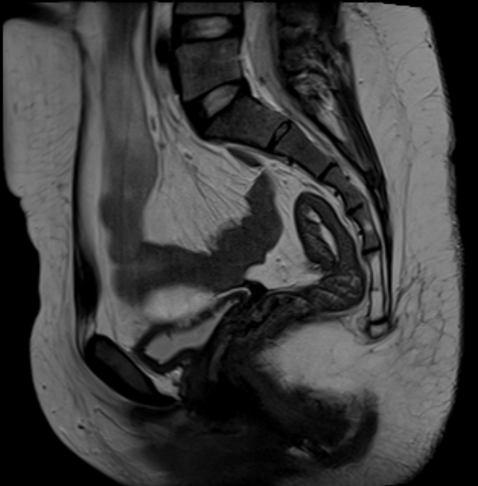 Mayer-Rokitansky-Küster-Hauser syndrome | Image | Radiopaedia.org