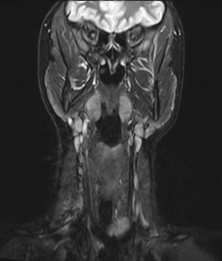 Benign hypertrophy of left masseter and left pterygoid muscles | Image ...