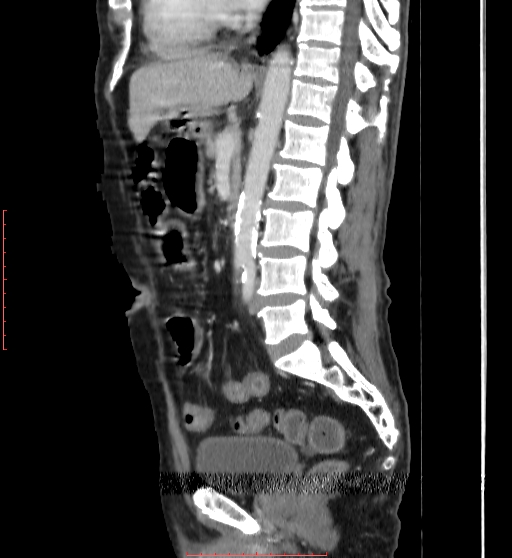 Chronic mesenteric ischemia | Image | Radiopaedia.org