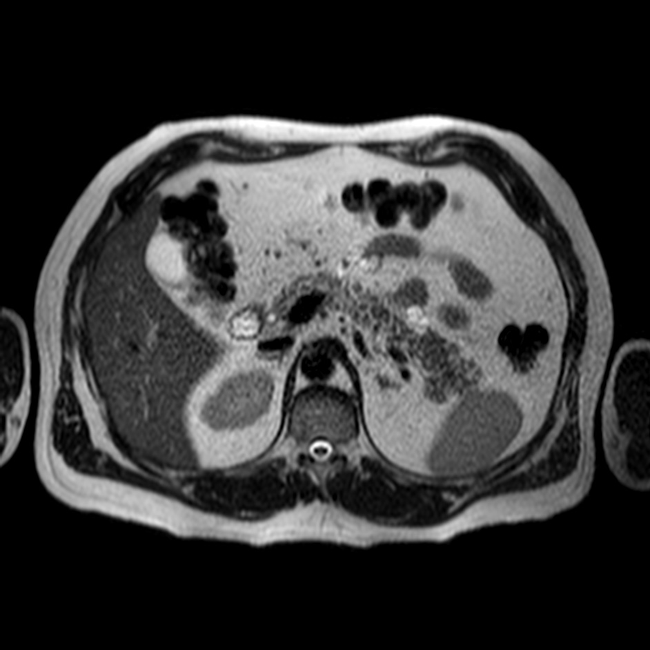 Neuroendocrine Tumor Of Head Of Pancreas Image Radiopaedia Org