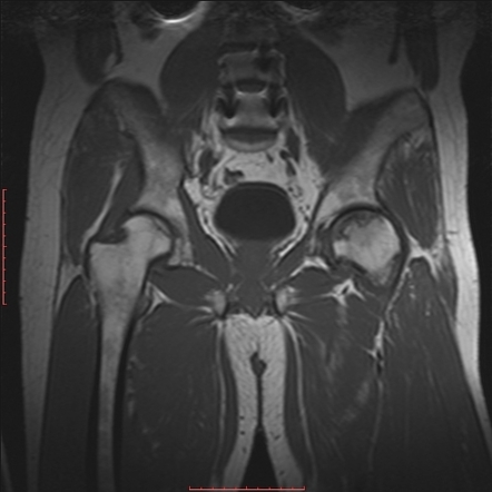 Avascular necrosis: bilateral hips | Image | Radiopaedia.org