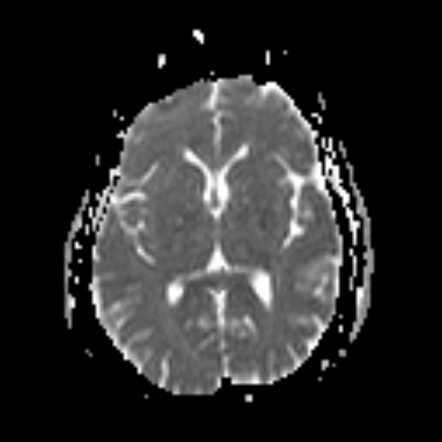 Amyotrophic Lateral Sclerosis Image Radiopaedia Org