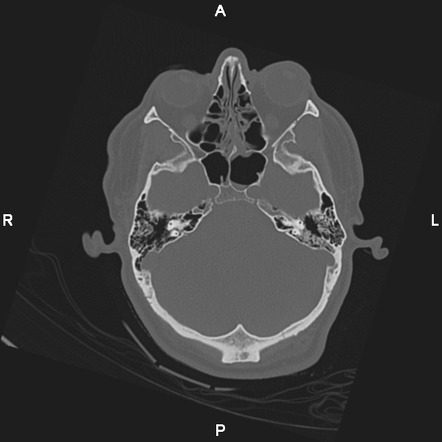 Mastoid diagonal transsphenoidal base of skull fracture | Image ...