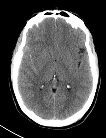 Mastoid diagonal transsphenoidal base of skull fracture | Image ...