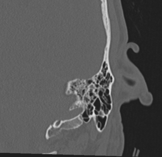 Mastoid diagonal transsphenoidal base of skull fracture | Image ...