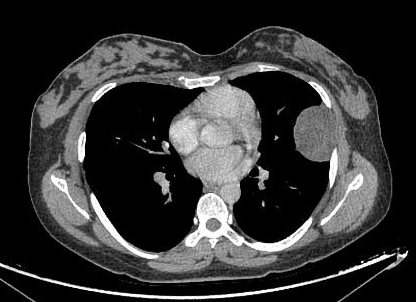 Multiple schwannomas | Image | Radiopaedia.org