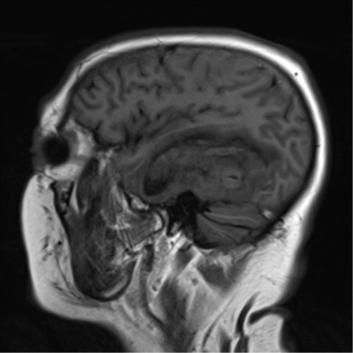 Cerebral venous hemorrhagic infarction | Image | Radiopaedia.org