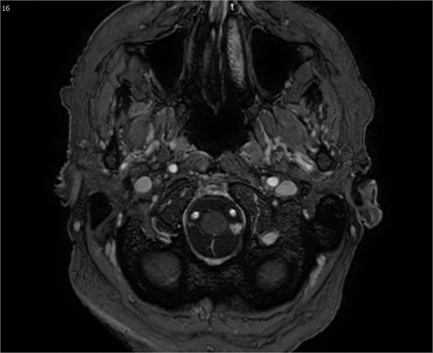 foramen magnum mri