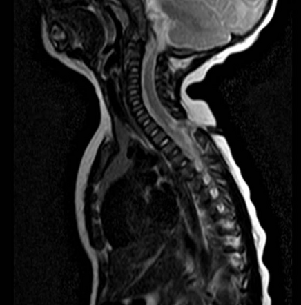 Congenital dermal sinus tract | Image | Radiopaedia.org