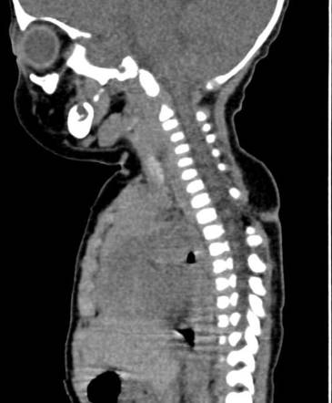 Congenital dermal sinus tract | Image | Radiopaedia.org