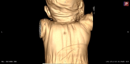 Pdf Infected Congenital Cervical Dermal Sinuses Leading To Spinal