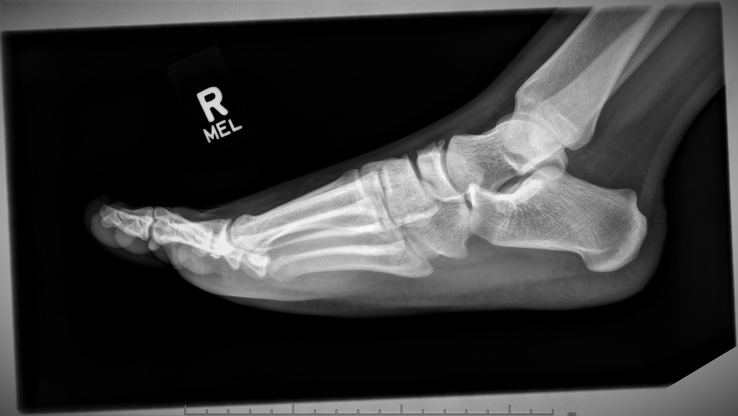 Dorsal Avulsion Fracture Of The Navicular Bone Image