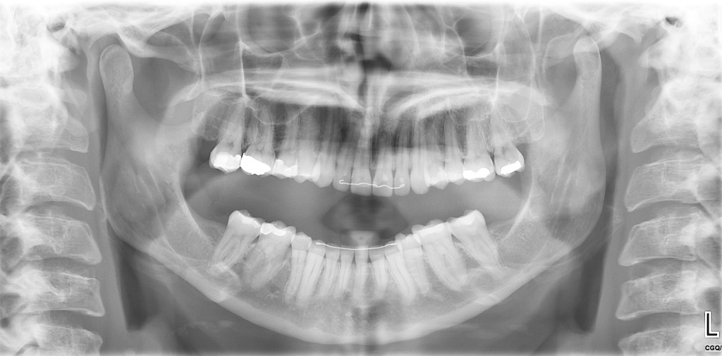 Dislocated Jaw X Ray