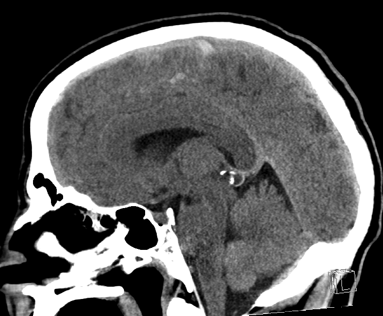 Mastoid diagonal transsphenoidal base of skull fracture | Image ...