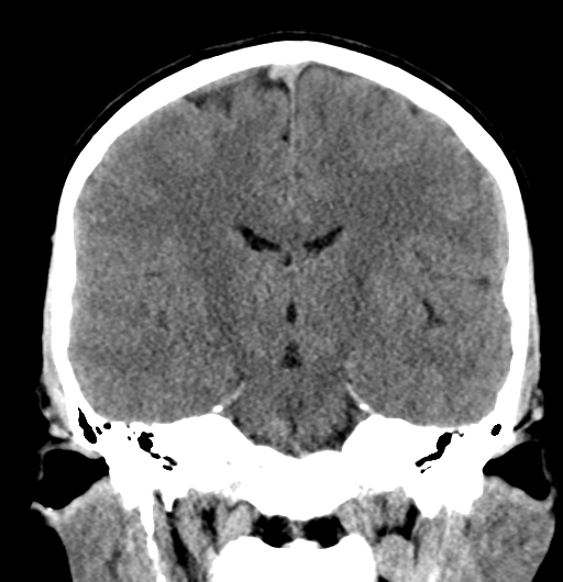 Cerebral fat embolism | Image | Radiopaedia.org