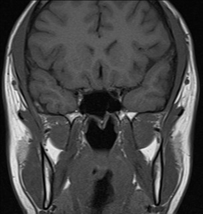 PEComa of the orbit | Image | Radiopaedia.org