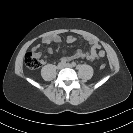 Urolithiasis | Radiology Case | Radiopaedia.org