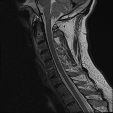 Chalk stick fracture | Image | Radiopaedia.org