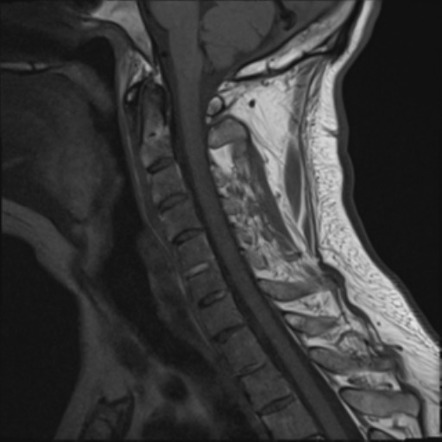 Chalk stick fracture | Image | Radiopaedia.org