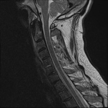 Chalk stick fracture | Image | Radiopaedia.org