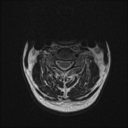 Chalk stick fracture | Image | Radiopaedia.org