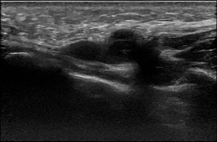 Alveolar rhabdomyosarcoma | Radiology Reference Article | Radiopaedia.org