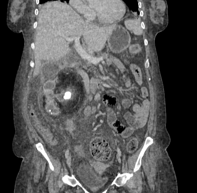 Xanthogranulomatous Pyelonephritis | Image | Radiopaedia.org