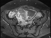 Whirlpool sign (ovarian torsion) | Radiology Reference Article ...