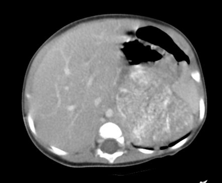 Metastatic neuroblastoma | Image | Radiopaedia.org