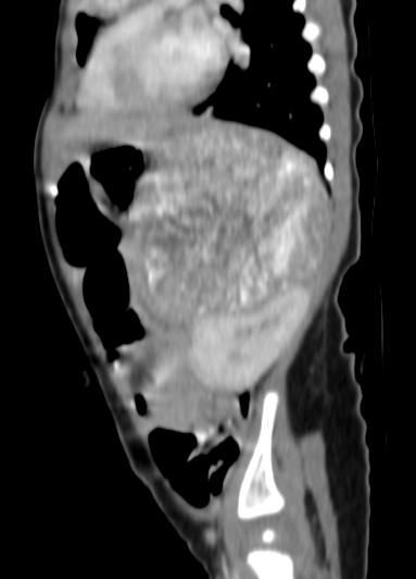 Metastatic neuroblastoma | Image | Radiopaedia.org