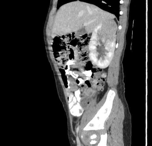 Translocation renal cell carcinoma | Image | Radiopaedia.org