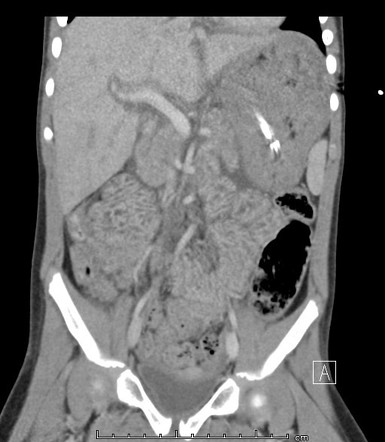 Shock bowel | Radiology Reference Article | Radiopaedia.org