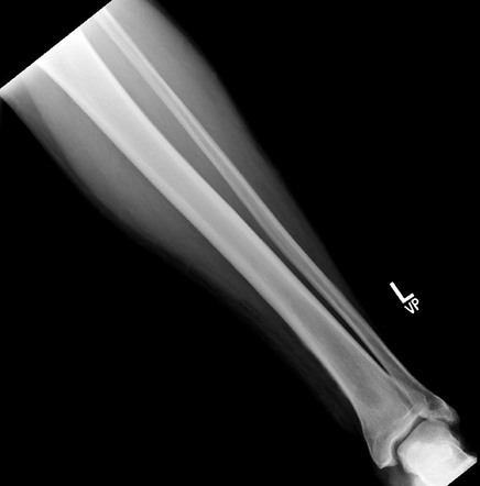 Fungal osteomyelitis | Radiology Case | Radiopaedia.org