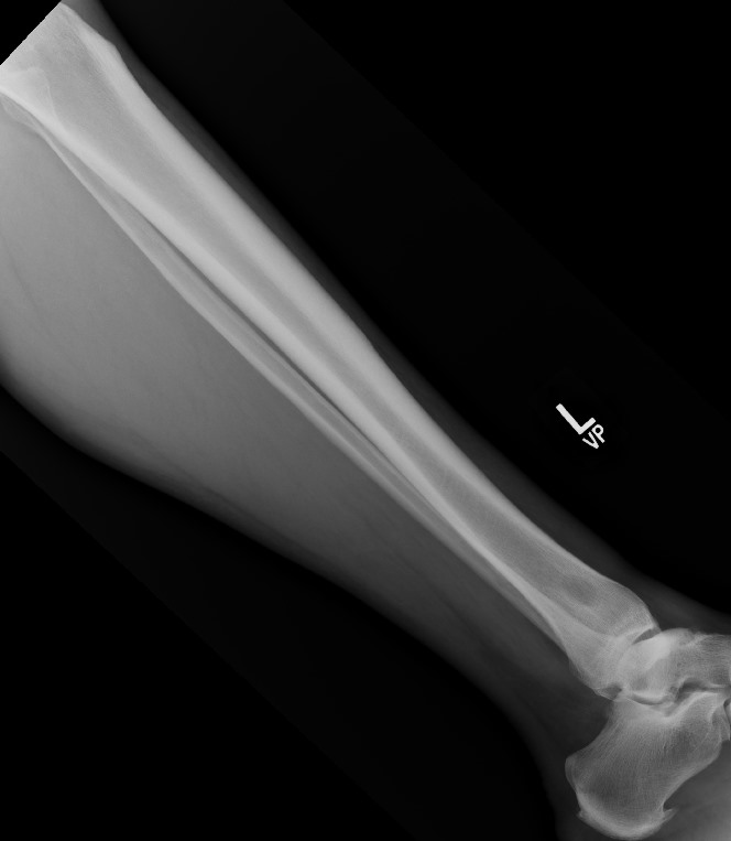 Fungal osteomyelitis | Image | Radiopaedia.org