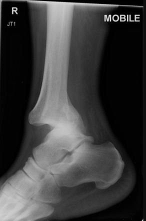 Ankle Fracture Dislocation Image Radiopaedia Org