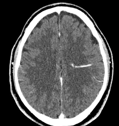 Developmental venous anomaly | Radiology Case | Radiopaedia.org