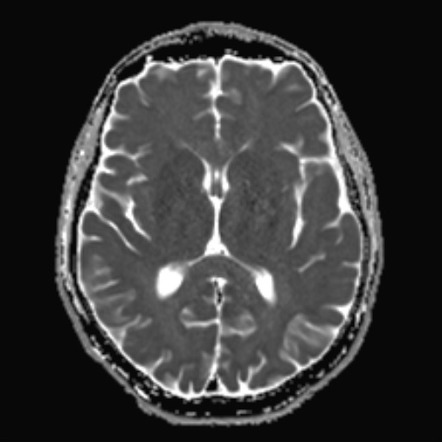 Diffuse astrocytoma IDH-1 mutant | Image | Radiopaedia.org