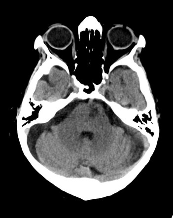 Pontine Infarct Radiology Case Radiopaedia Org